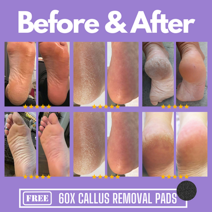 GOCALLUS | MAGIC CALLUS REMOVER